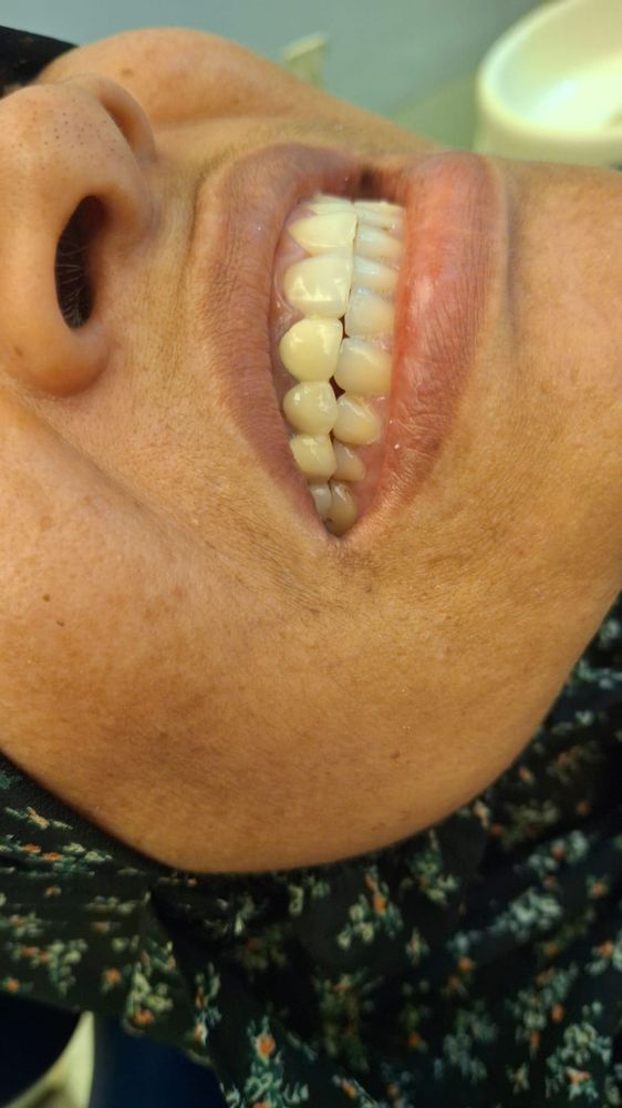 Worn Teeth Restored with Crowns — after treatment