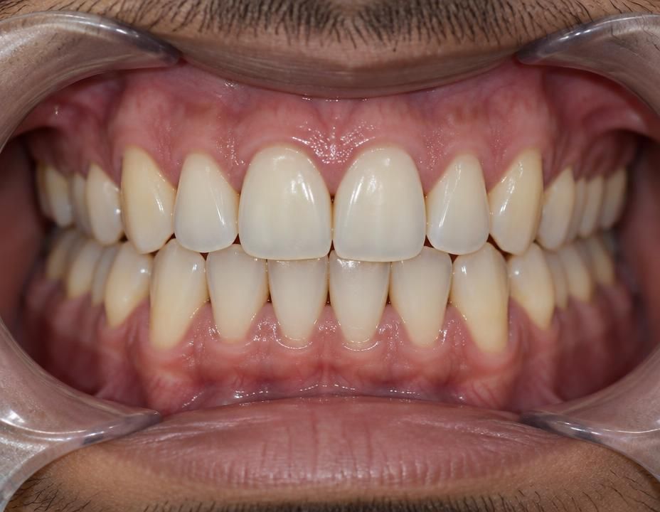 Single Front-Tooth Implant — after treatment